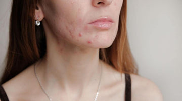 CBD Oil for Acne- How Does It Help?